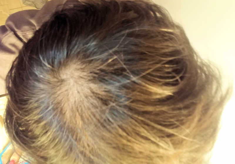 3 months Minoxidil usage hair dry