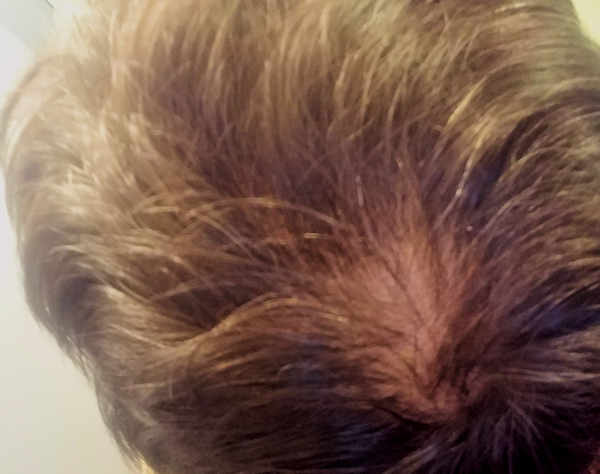 dry hair 9 days into Minoxidil treatment