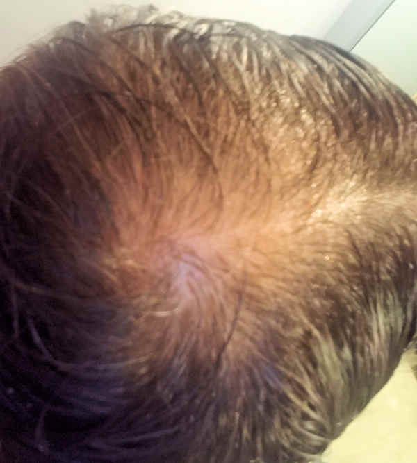 wet hair 9 days into Minoxidil treatment
