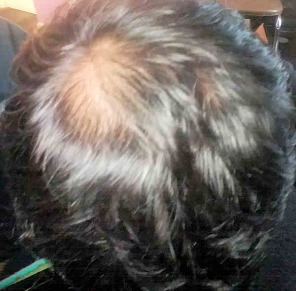Balding crown male scalp with dry hair