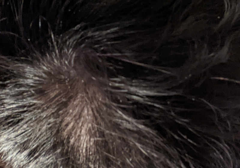 Crown of head after one year of Minoxidil use