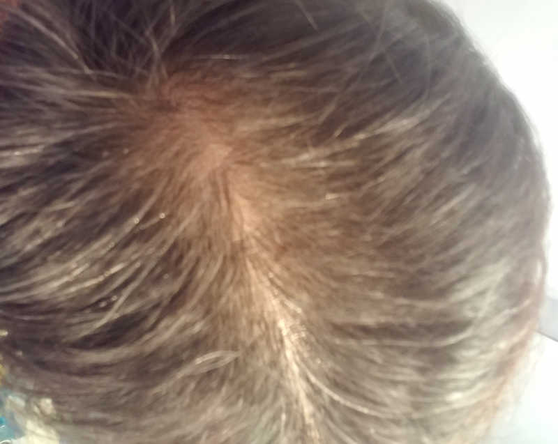 male pattern baldenss after 9 weeks on Rogaine