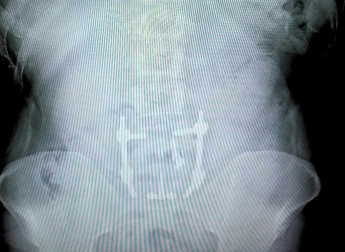spinal fusion hardware cage