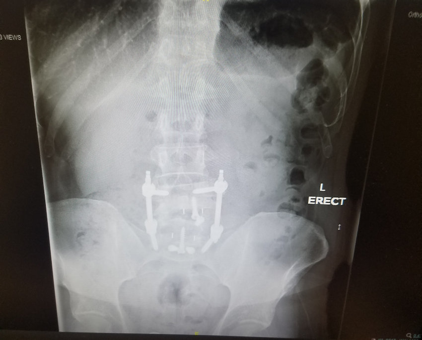 spinal fusion x-ray 14 months after surgery